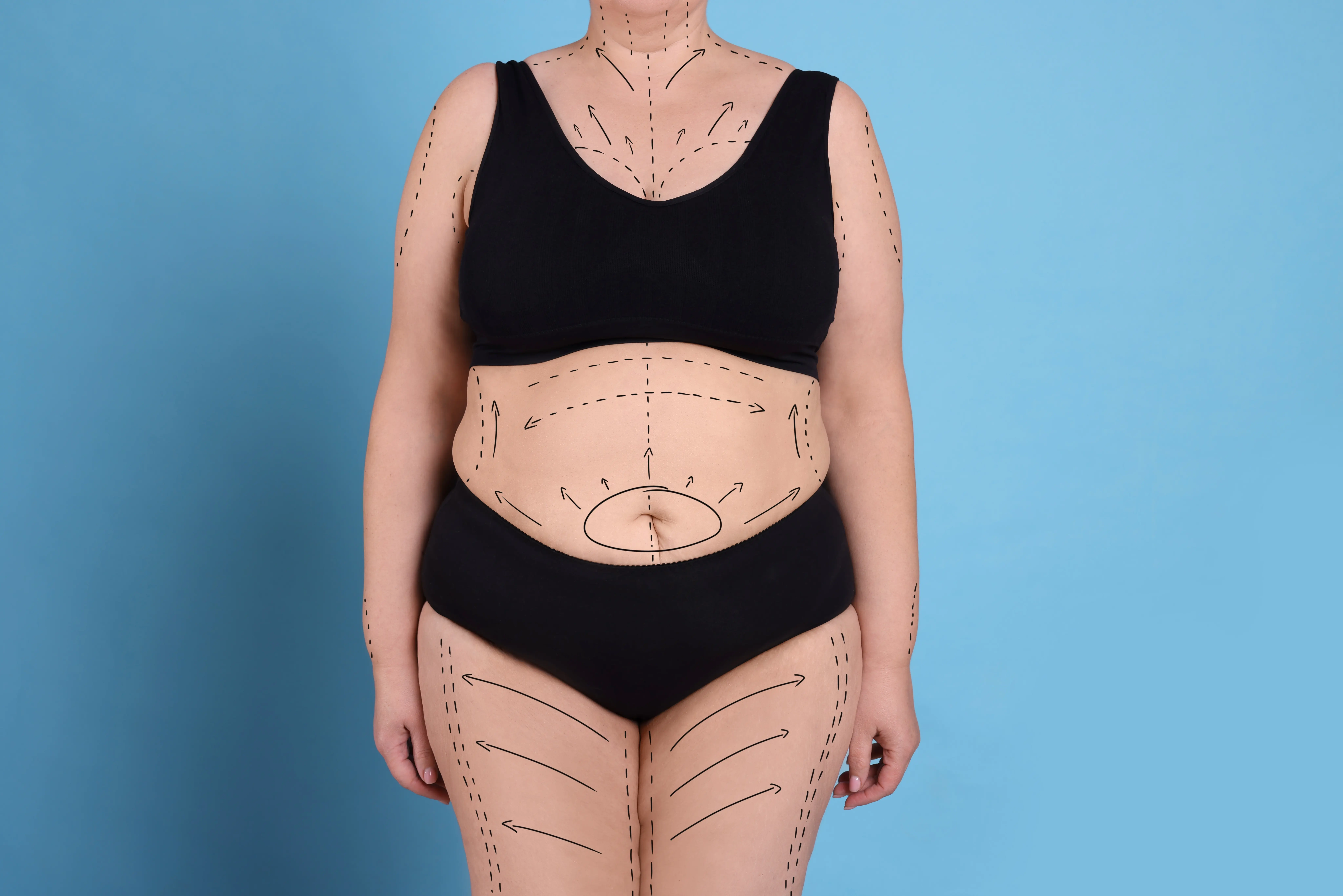 Body Lift procedure